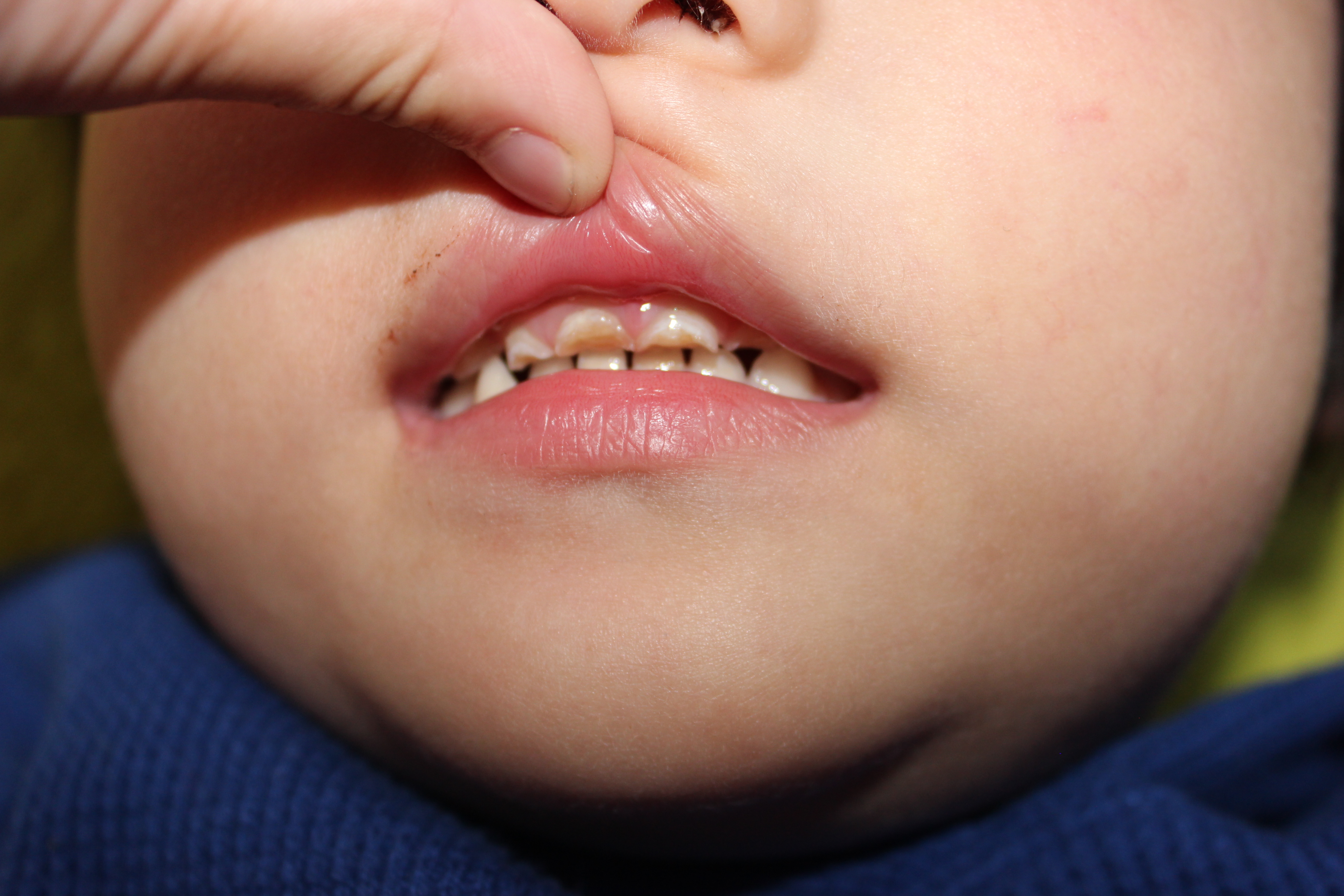 エナメル質形成不全と虫歯の関係 原因 治療法は